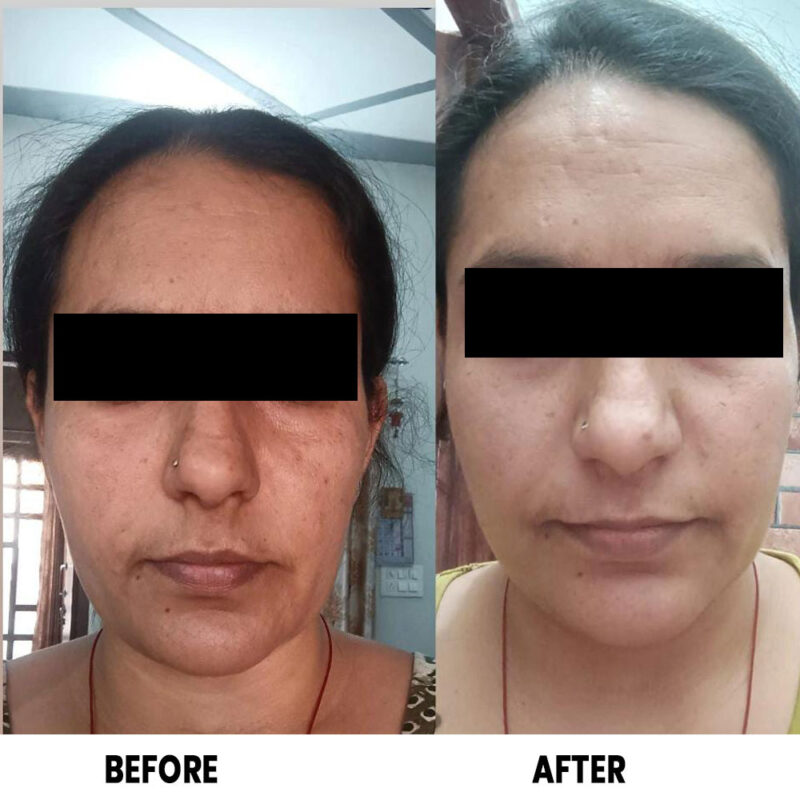 HYPER PIGMENTATION CREAM HELPS TO CONTROL PIGMENTATION & DARK PATCHES ON THE SKIN. - Image 5