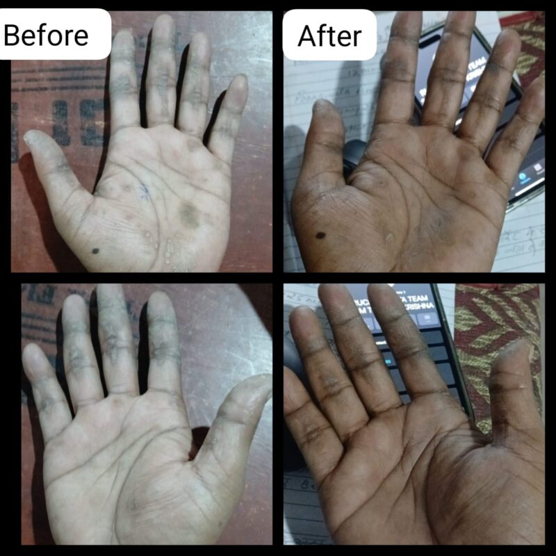 Karokaya Dermal Cream Manages skin eruptions, urticaria, hives & psoriasis. - Image 3