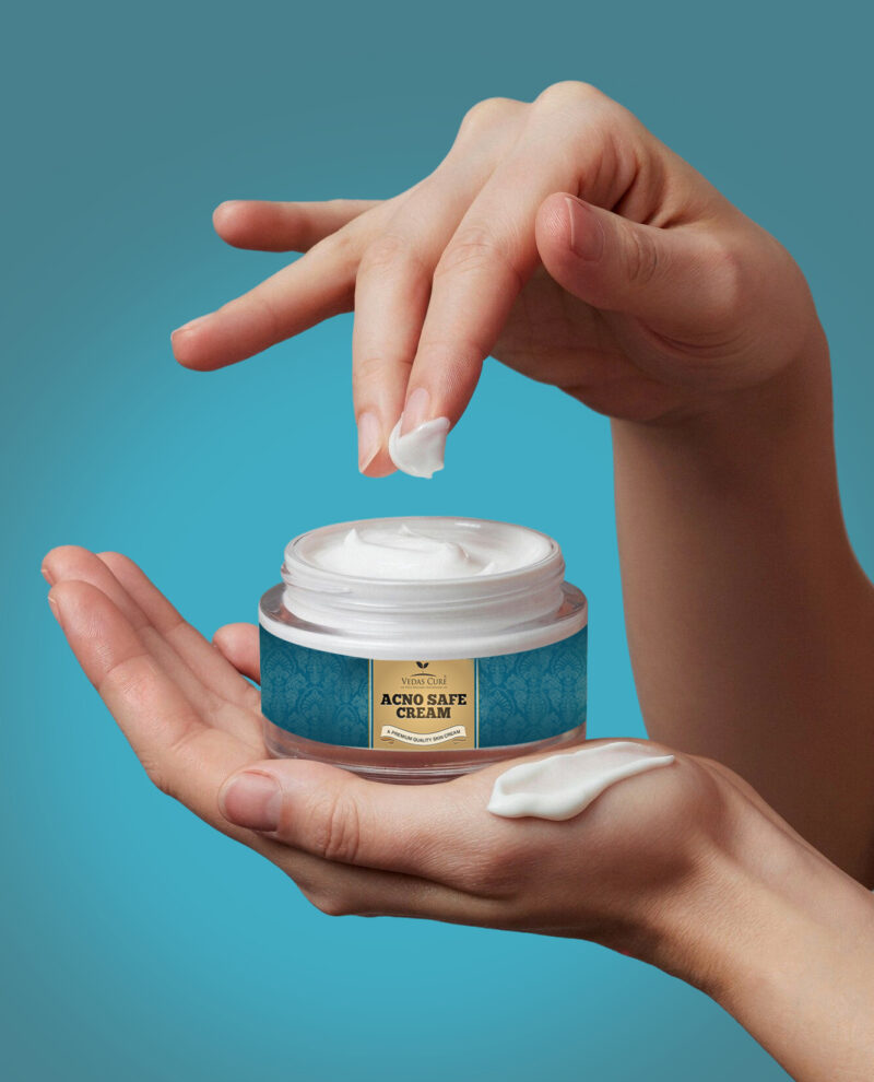 Acno Safe Cream - Vedas Cure