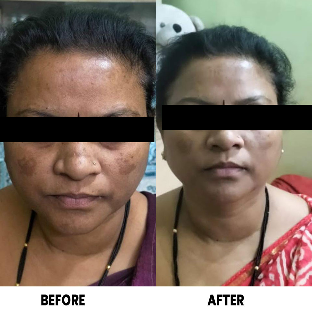 Depigmela Skin  Brightening Cream - Image 4