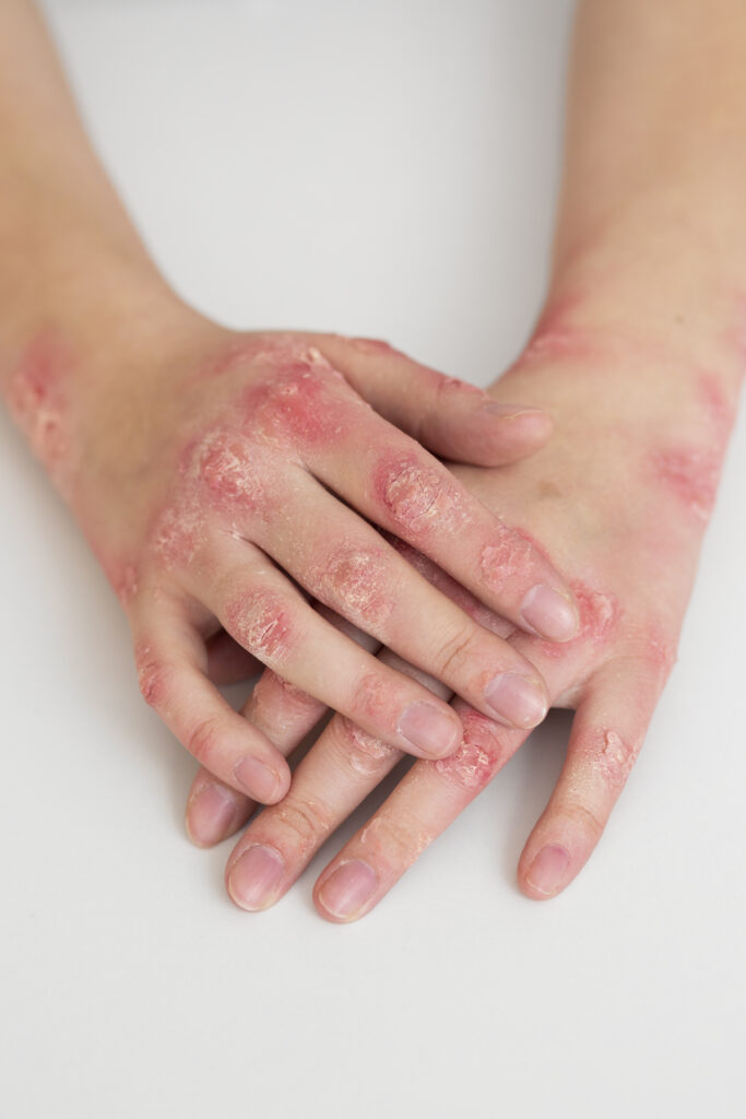 hands patient suffering from psoriasis (1)