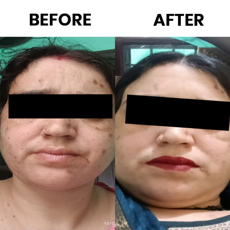 Pigmela Skin Gel Helps to improve complexion and prevent skin darkening. - Image 4