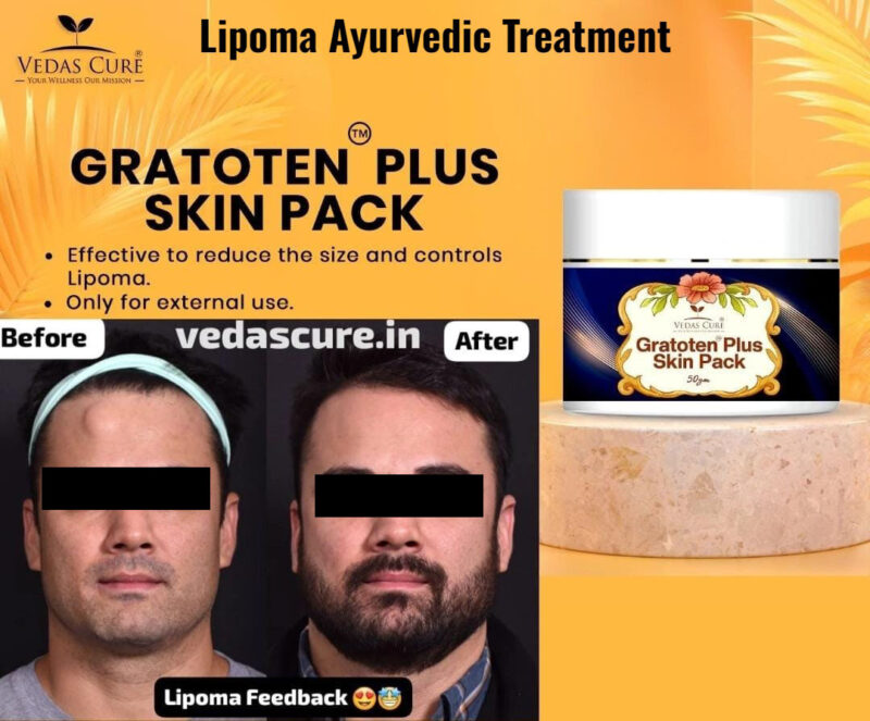 Gratoten plus Skin Pack Effective to reduce the size and controls Lipoma - Image 4