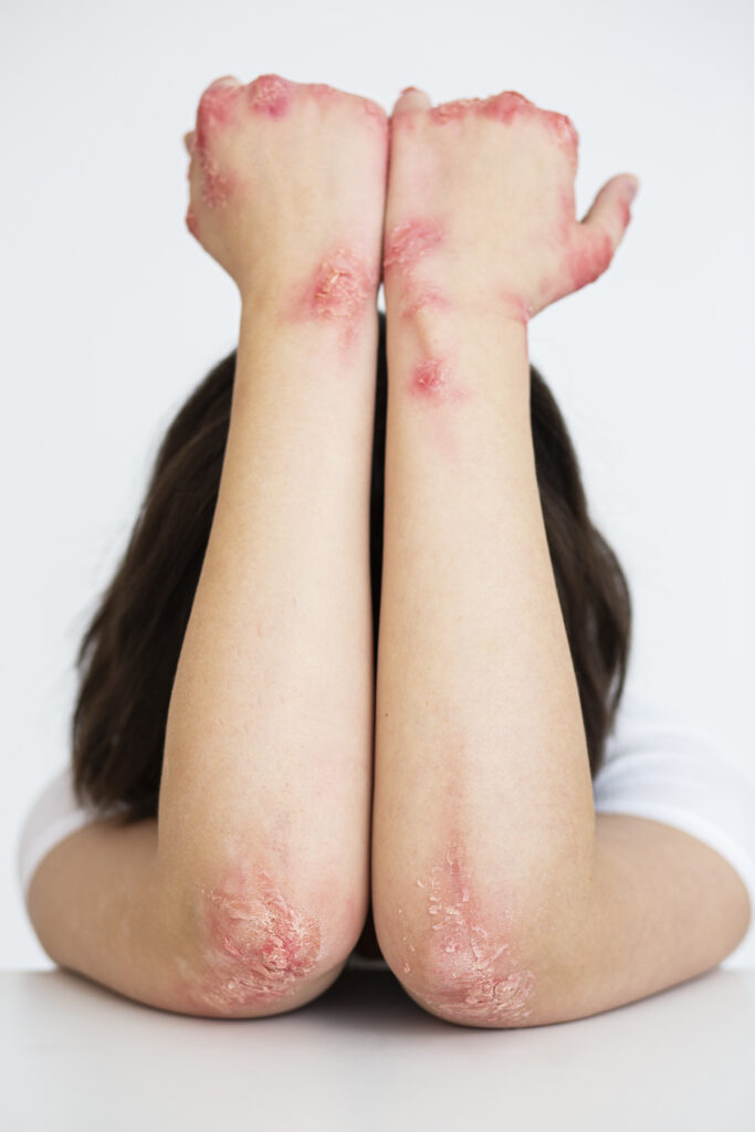 hands patient suffering from psoriasis (2)